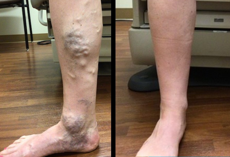 Immediate, Non-Surgical Relief Available for Varicose Veins