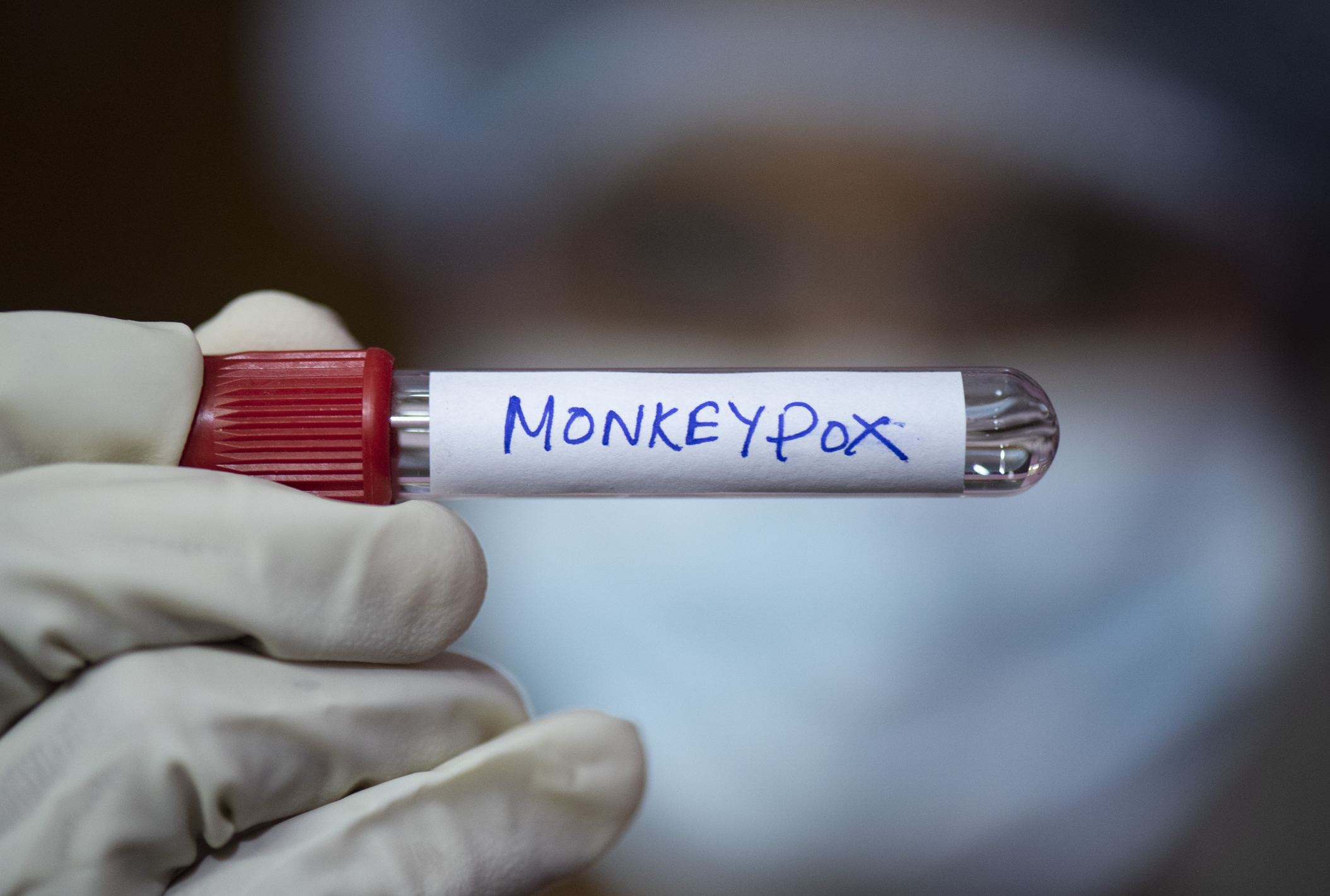 Monkeypox 101: Symptoms, Treatment, and Prevention