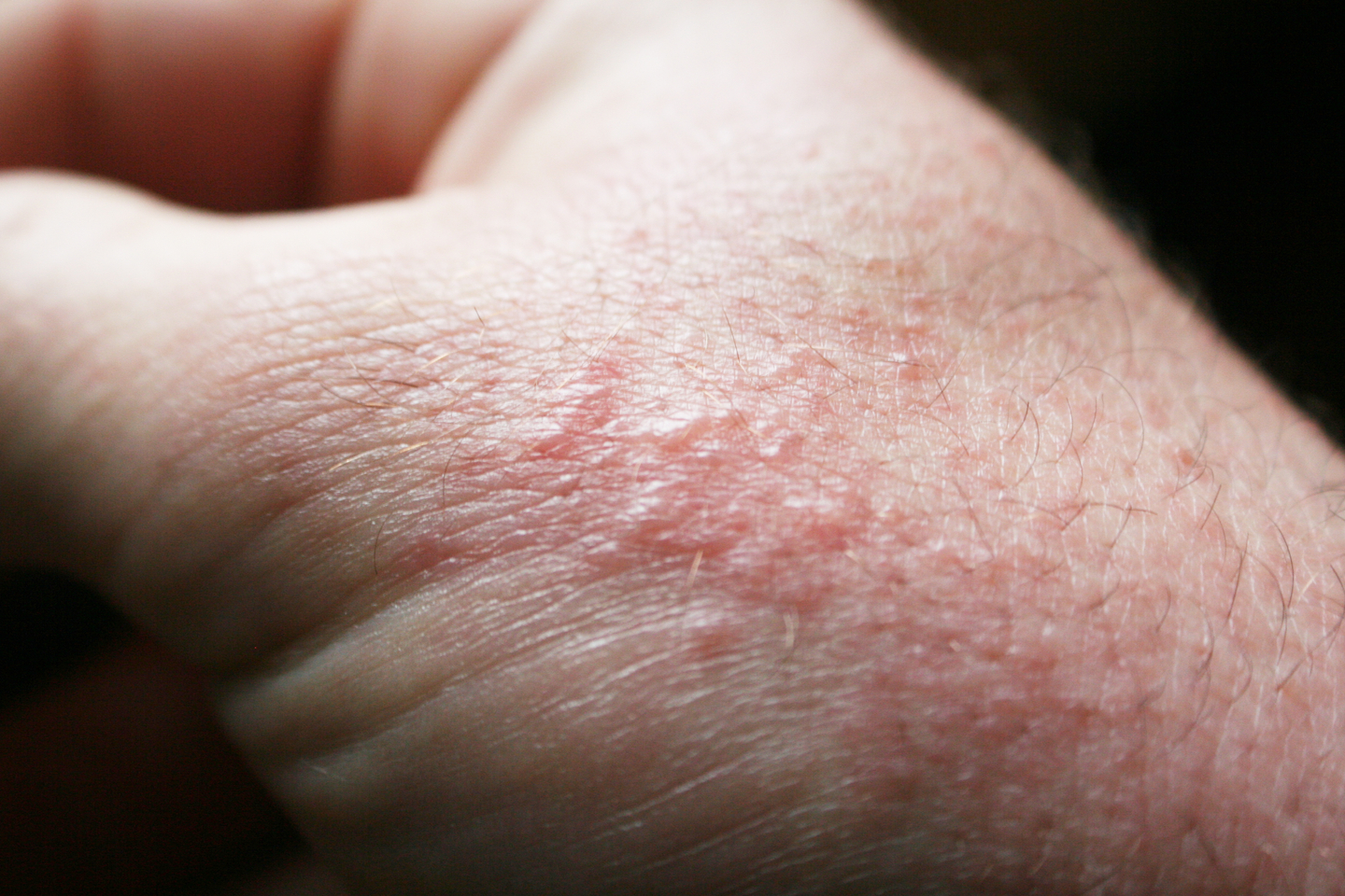 Poison Ivy Rash, Poison Oak, Poison Sumac: Symptoms, Causes