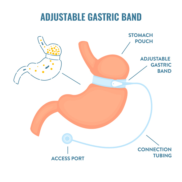 gastric band surgery illustration