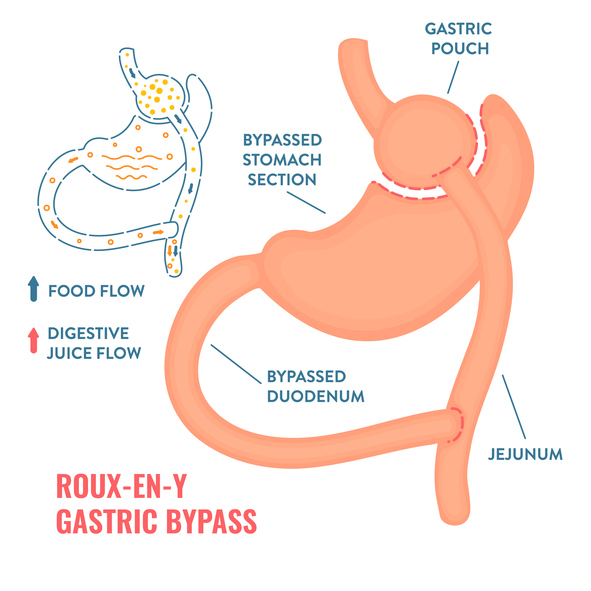 gastric bypass surgery illustration