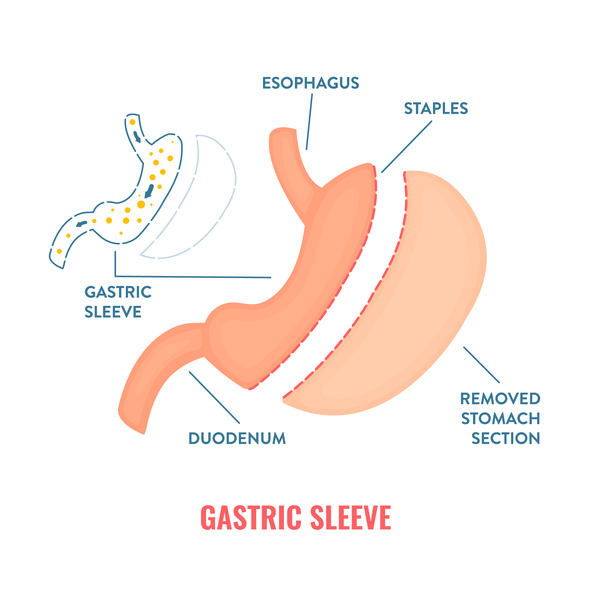 gastric bypass surgery illustration